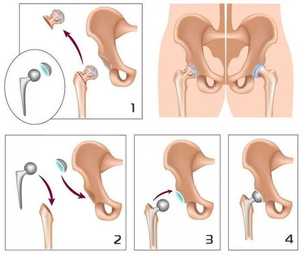 Remplacer une articulation douloureuse par une prothèse