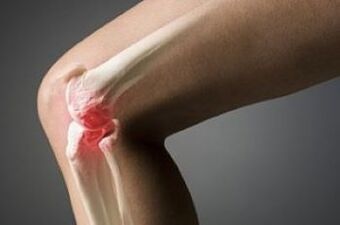 L'arthrose de l'articulation du genou est une blessure au tissu du cartilage