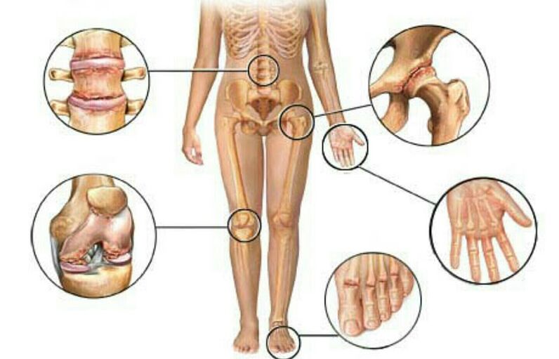 types et degrés d'arthrose