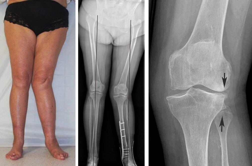 L'arthrose avancée des articulations du genou est clairement visible même sans radiographie. 