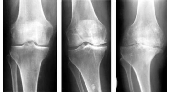 Une mesure diagnostique obligatoire lors de l'identification de l'arthrose du genou est une radiographie. 